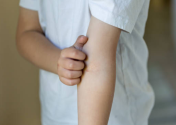 Esta enfermedad puede provocar asma y alergia alimentaria en niños