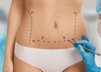 ¿Listo para lucir un abdomen plano en verano? Consíguelo con cirugía corporal