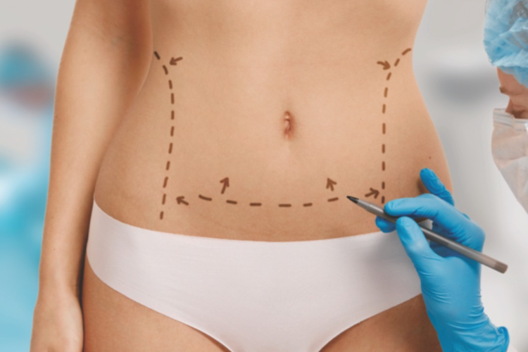 ¿Listo para lucir un abdomen plano en verano? Consíguelo con cirugía corporal