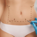 ¿Listo para lucir un abdomen plano en verano? Consíguelo con cirugía corporal