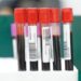Reportan 16 casos de dengue y un deceso por COVID-19