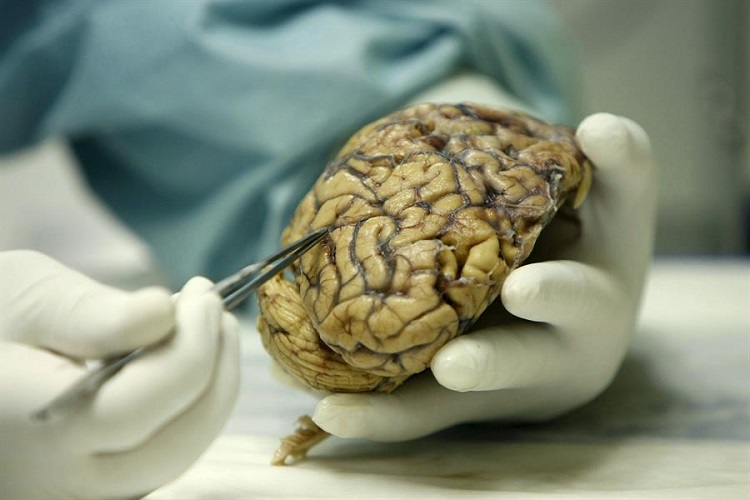 Científicos de Cuba y México desarrollan investigaciones para tratar el Alzheimer