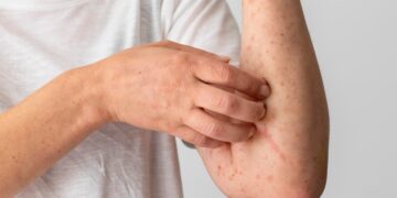 Puebla, sin casos de dengue en últimas 24 horas