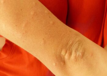 No se reportan casos de dengue en últimas 24 horas