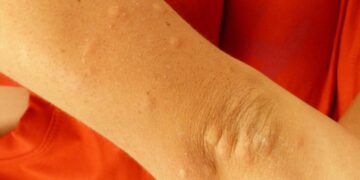 No se reportan casos de dengue en últimas 24 horas