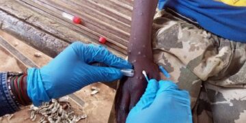 Descartan casos de mpox o viruela símica en Puebla