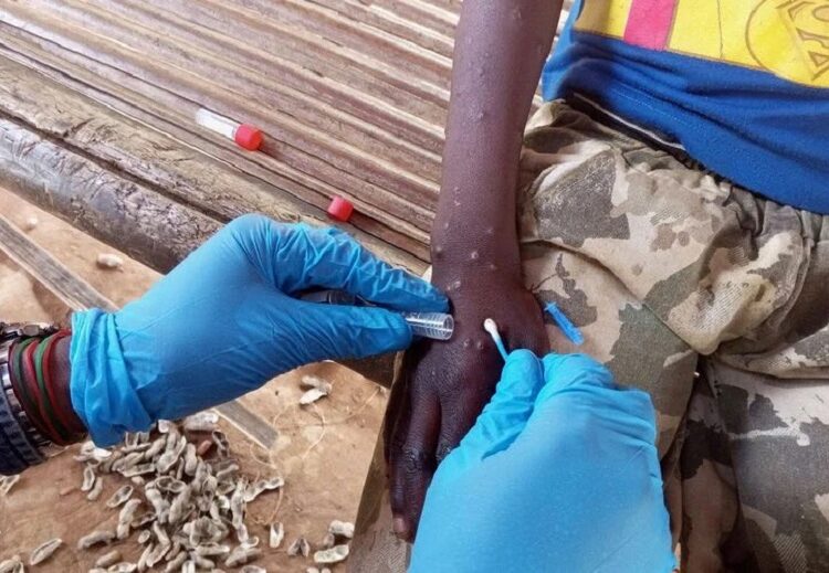 Descartan casos de mpox o viruela símica en Puebla