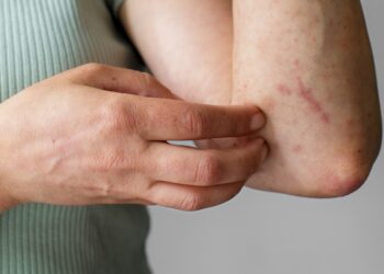 Dengue supera 2 mil contagios acumulados en Puebla