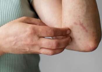 Supera Puebla los 4 mil contagios acumulados de dengue en el año
