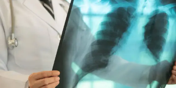 Issstep se suma al combate frontal para erradicar la tuberculosis