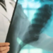 Issstep se suma al combate frontal para erradicar la tuberculosis