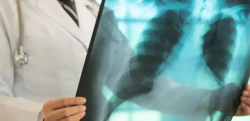 Issstep se suma al combate frontal para erradicar la tuberculosis