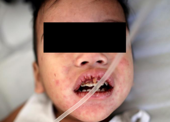 Niña de 8 años, no vacunada, muere de sarampión