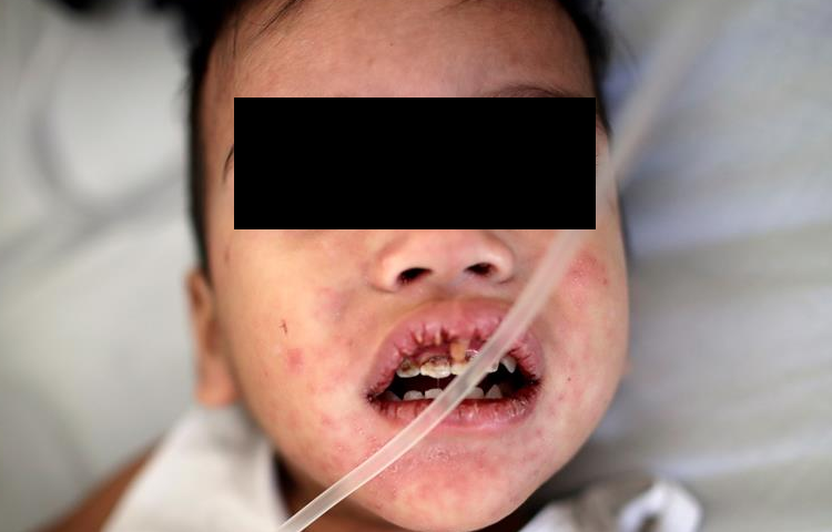 Niña de 8 años, no vacunada, muere de sarampión