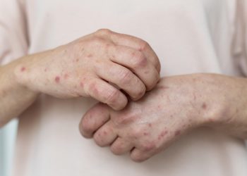 México espera erradicar casos de sarampión en noviembre