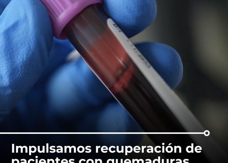 IMSS Bienestar impulsa recuperación acelerada de pacientes con quemaduras mediante terapia innovadora en Estado de México