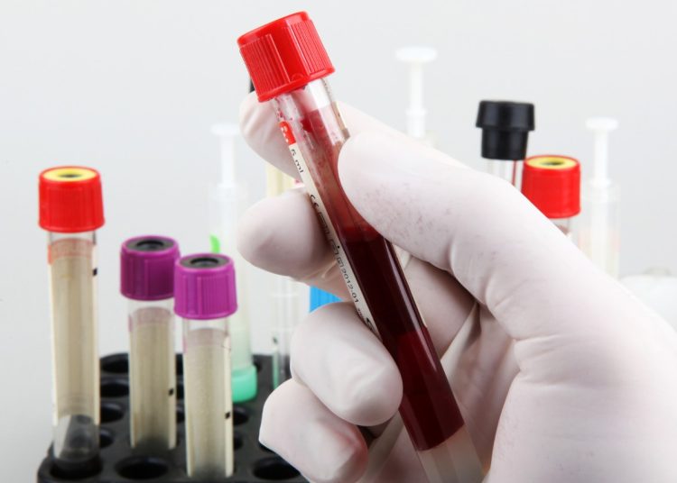 Importante detectar casos de Síndrome de Quilomicronemia Familiar
