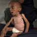 Gaza registra 10 muertos por desnutrición el viernes, 3 de ellos eran niños