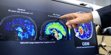 Científicos latinos en EE.UU. detectan biomarcador temprano de Alzheimer