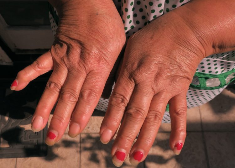 Osteoartritis afecta al 60% de mexicanos y empeora con el frío