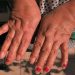 Osteoartritis afecta al 60% de mexicanos y empeora con el frío
