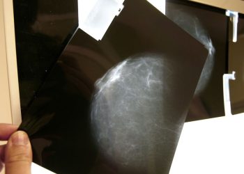 Aumentará 34% el cáncer de mama en 2050