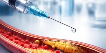 Una inyección contra el colesterol de por vida