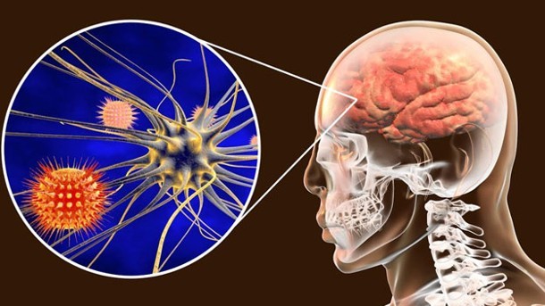 Meningitis: prevención y retos para México