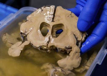 México presenta innovador tratamiento para aneurismas cerebrales