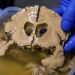México presenta innovador tratamiento para aneurismas cerebrales